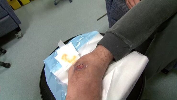 Melbourne’ün kuzeyinde hızla yayılan yeni bir bakteri