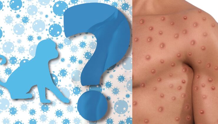 AVUSTRALYA’DA ARTAN MONKEYPOX VAKALARI