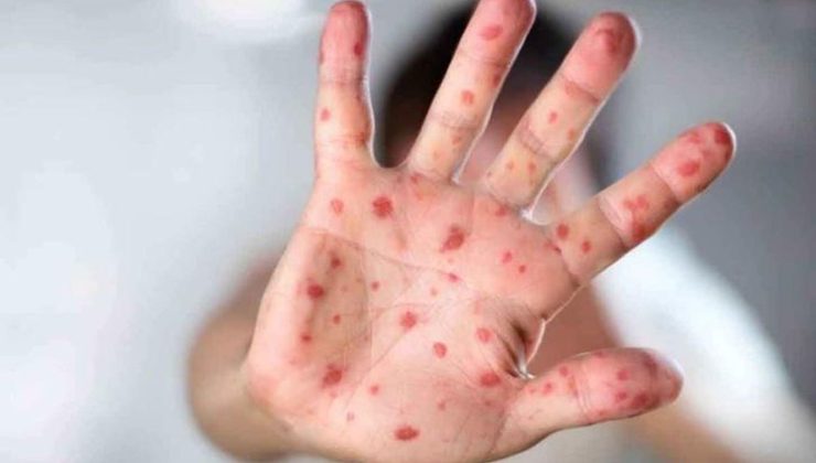 YENİ VİRÜS Covid’e benzer belirtiler ama değil!