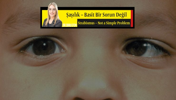 Şaşılık ‘Basit Bir Sorun Değil’ ENGLISH <strong>Strabismus – Not a Simple Problem  </strong>
