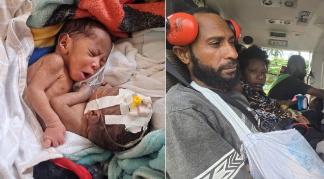 Yapışık İkizler Tedavi İçin Avustralya’da